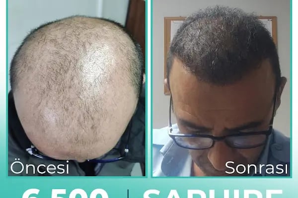 Carla Clinic Saç Ekim Merkezi Avcılar - Resim 8