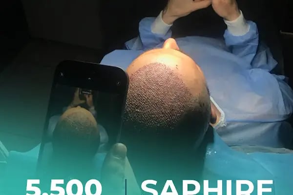 Carla Clinic Saç Ekim Merkezi Avcılar - Resim 9