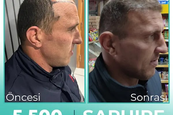 Carla Clinic Saç Ekim Merkezi Avcılar - Resim 18