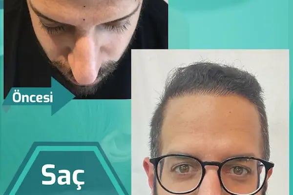 Carla Clinic Saç Ekim Merkezi Avcılar - Resim 13