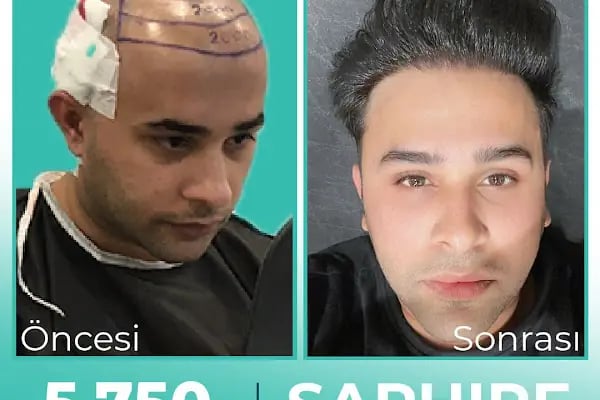 Carla Clinic Saç Ekim Merkezi Avcılar - Resim 11