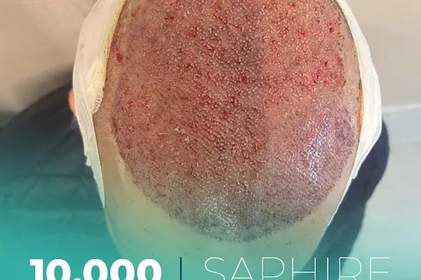 Carla Clinic Saç Ekim Merkezi Avcılar - Resim 4