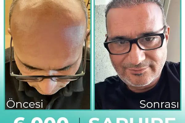 Carla Clinic Saç Ekim Merkezi Avcılar - Resim 16