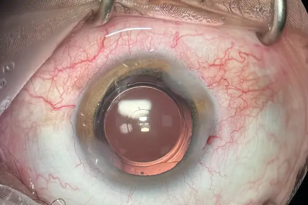 Op. Dr. Ufuk ÜRDEM Göz Hastalıkları ve Cerrahisi Uzmanı. Lazer, Akıllı Lens, Göz Kapağı Estetiği, Şaşılık, Katarakt - Resim 13