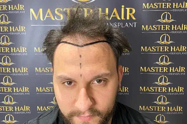 Master Hair Transplant - Resim 4