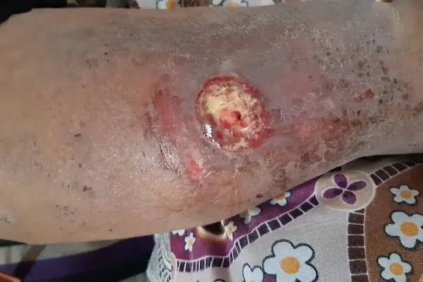 Op. Dr. İlker ZAN | Alanya Varis Tedavi | Vein Treatment | Флеболог - Resim 16