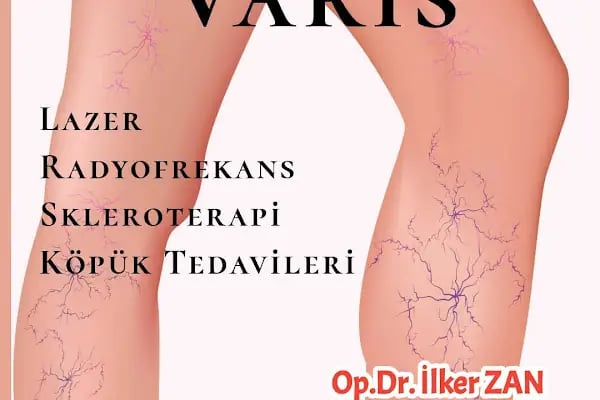 Op. Dr. İlker ZAN | Alanya Varis Tedavi | Vein Treatment | Флеболог - Resim 13