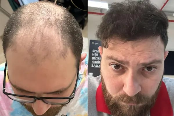 Ozan Ablay Hair Transplant - Resim 11
