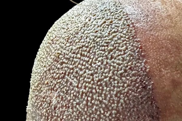 Ozan Ablay Hair Transplant - Resim 14