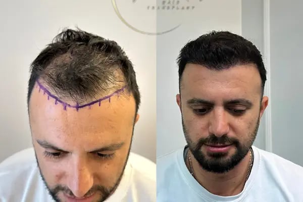 Ozan Ablay Hair Transplant - Resim 15