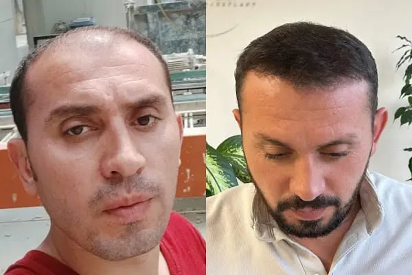 Ozan Ablay Hair Transplant - Resim 8