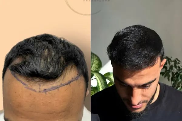 Ozan Ablay Hair Transplant - Resim 18