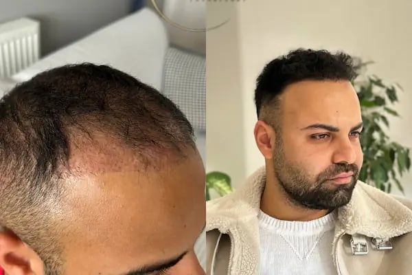 Ozan Ablay Hair Transplant - Resim 6