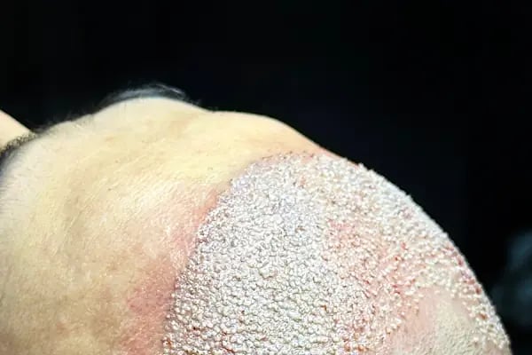 Ozan Ablay Hair Transplant - Resim 13