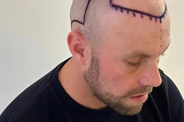 Ozan Ablay Hair Transplant - Resim 19