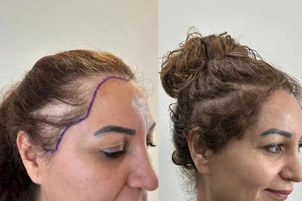 Ozan Ablay Hair Transplant - Resim 4