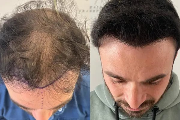 Ozan Ablay Hair Transplant - Resim 9