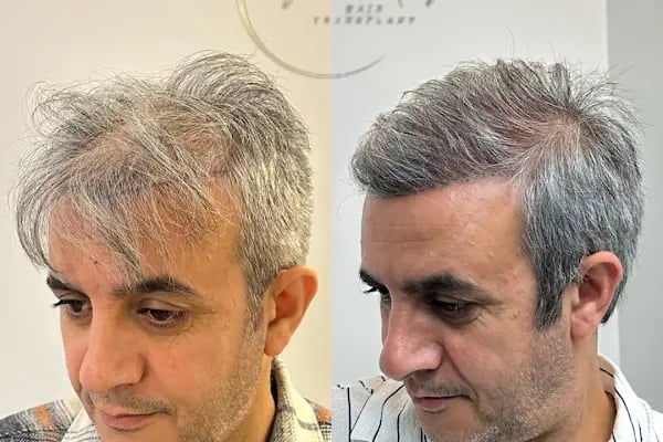 Ozan Ablay Hair Transplant - Resim 10