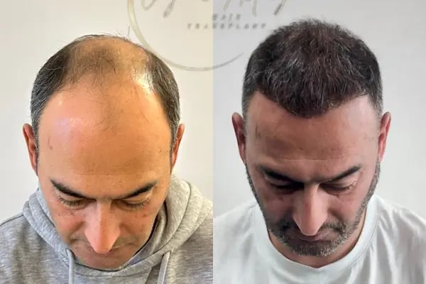 Ozan Ablay Hair Transplant - Resim 1