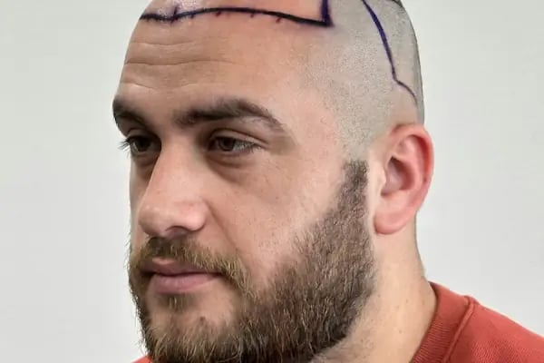 Ozan Ablay Hair Transplant - Resim 12