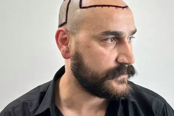 Ozan Ablay Hair Transplant - Resim 16