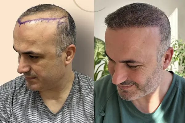Ozan Ablay Hair Transplant - Resim 17