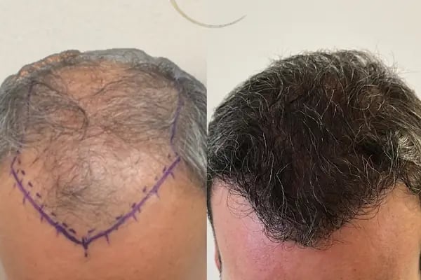 Ozan Ablay Hair Transplant - Resim 7
