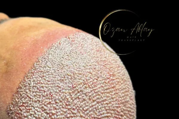 Ozan Ablay Hair Transplant - Resim 5