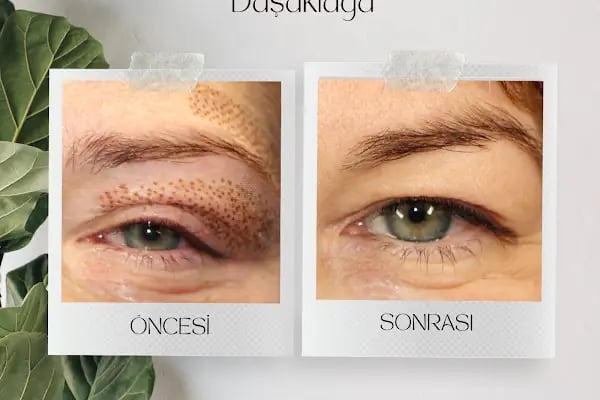 İpek Parsak Güzellik Merkezi - Diode Lazer Epilasyon - Hydrafacial Cilt Bakımı - Resim 10