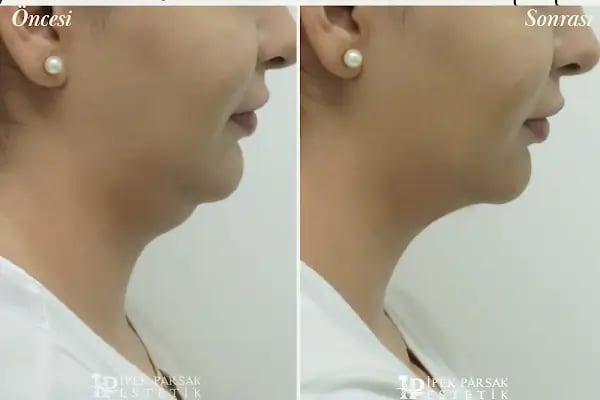 İpek Parsak Güzellik Merkezi - Diode Lazer Epilasyon - Hydrafacial Cilt Bakımı - Resim 13