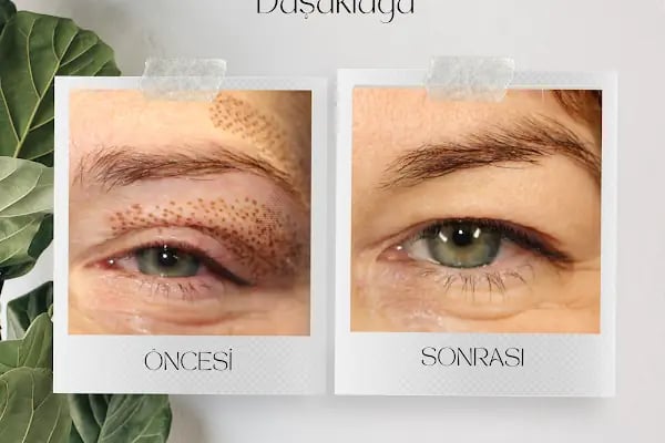 İpek Parsak Güzellik Merkezi - Diode Lazer Epilasyon - Hydrafacial Cilt Bakımı - Resim 9