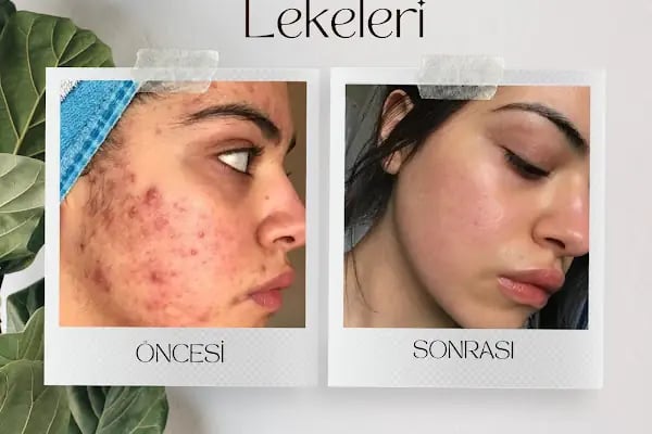 İpek Parsak Güzellik Merkezi - Diode Lazer Epilasyon - Hydrafacial Cilt Bakımı - Resim 11
