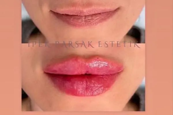 İpek Parsak Güzellik Merkezi - Diode Lazer Epilasyon - Hydrafacial Cilt Bakımı - Resim 17