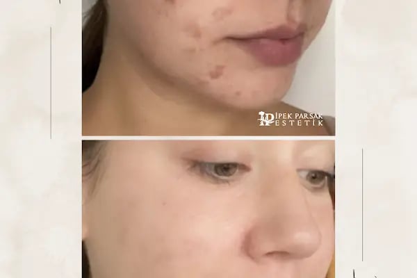 İpek Parsak Güzellik Merkezi - Diode Lazer Epilasyon - Hydrafacial Cilt Bakımı - Resim 19