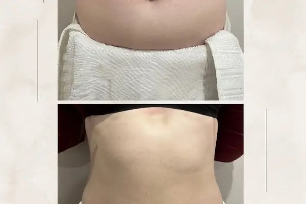 İpek Parsak Güzellik Merkezi - Diode Lazer Epilasyon - Hydrafacial Cilt Bakımı - Resim 20