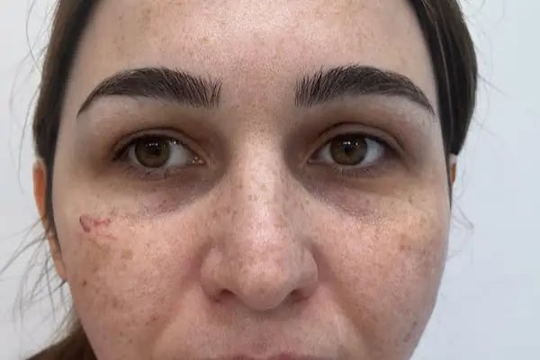 İpek Parsak Güzellik Merkezi - Diode Lazer Epilasyon - Hydrafacial Cilt Bakımı - Resim 3
