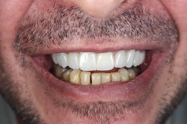 Diş hekimi Mehmet ÖZER-Alanya Diş hekimi -Diş kliniği-İmplant -Zirkonyum-Acil Diş-Kanal Tedavisi-Porselen kaplama-Dentist- - Resim 17