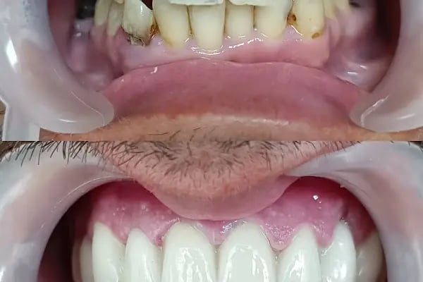 Diş hekimi Mehmet ÖZER-Alanya Diş hekimi -Diş kliniği-İmplant -Zirkonyum-Acil Diş-Kanal Tedavisi-Porselen kaplama-Dentist- - Resim 2