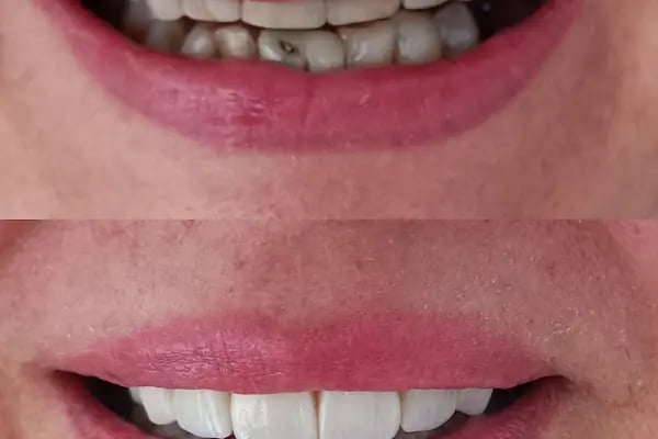 Diş hekimi Mehmet ÖZER-Alanya Diş hekimi -Diş kliniği-İmplant -Zirkonyum-Acil Diş-Kanal Tedavisi-Porselen kaplama-Dentist- - Resim 13