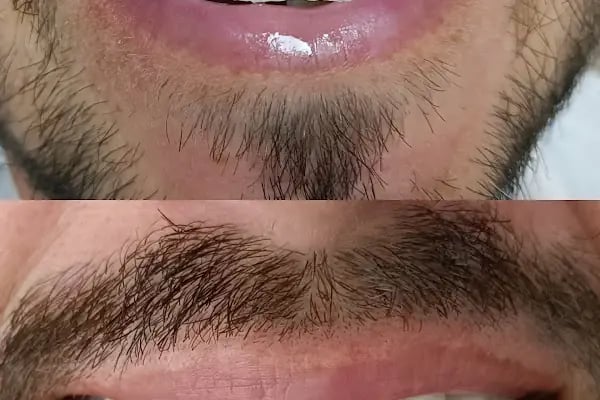 Diş hekimi Mehmet ÖZER-Alanya Diş hekimi -Diş kliniği-İmplant -Zirkonyum-Acil Diş-Kanal Tedavisi-Porselen kaplama-Dentist- - Resim 14