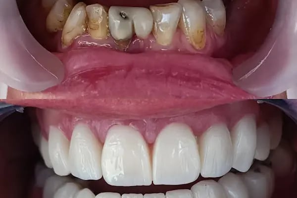 Diş hekimi Mehmet ÖZER-Alanya Diş hekimi -Diş kliniği-İmplant -Zirkonyum-Acil Diş-Kanal Tedavisi-Porselen kaplama-Dentist- - Resim 1