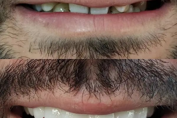 Diş hekimi Mehmet ÖZER-Alanya Diş hekimi -Diş kliniği-İmplant -Zirkonyum-Acil Diş-Kanal Tedavisi-Porselen kaplama-Dentist- - Resim 15