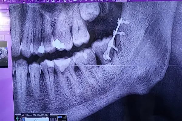 Diş hekimi Mehmet ÖZER-Alanya Diş hekimi -Diş kliniği-İmplant -Zirkonyum-Acil Diş-Kanal Tedavisi-Porselen kaplama-Dentist- - Resim 16