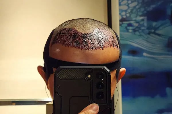 Vera Clinic | Hair Transplant Clinic in Turkey - Resim 20