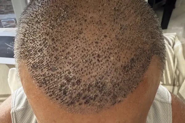 Vera Clinic | Hair Transplant Clinic in Turkey - Resim 6