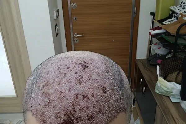 Vera Clinic | Hair Transplant Clinic in Turkey - Resim 15