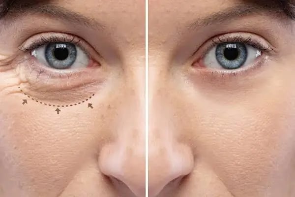 Uzm. Dr. İrem Hengirmen Acu | Dermatoloji &amp; Kozmetoloji &amp; Otolog Mikrogreft - Resim 5