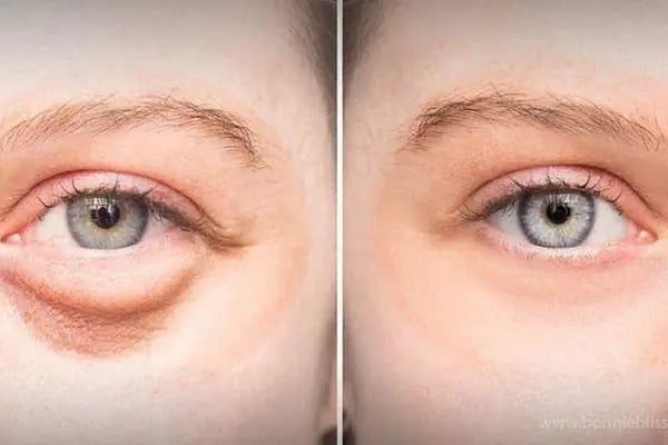 Uzm. Dr. İrem Hengirmen Acu | Dermatoloji &amp; Kozmetoloji &amp; Otolog Mikrogreft - Resim 4