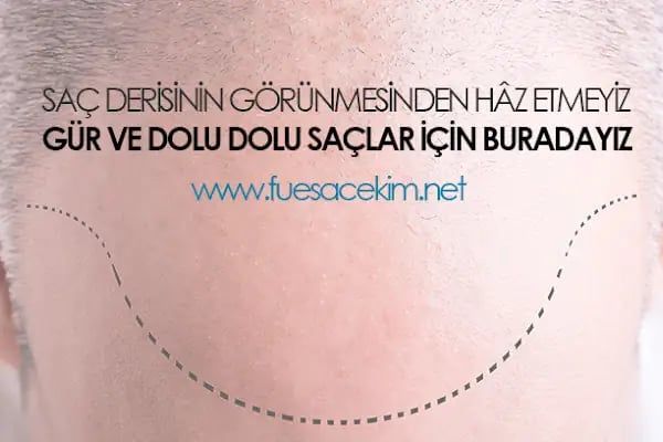 Gaziantep Saç Ekim - Fue Saç Ekim Merkezi fueestetik - Resim 2