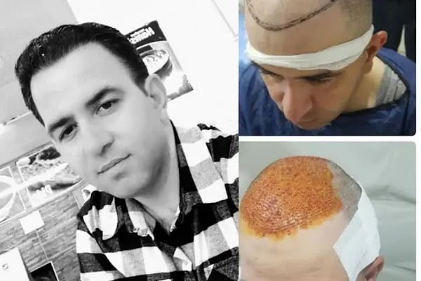Gaziantep Saç Ekim - Fue Saç Ekim Merkezi fueestetik - Resim 11